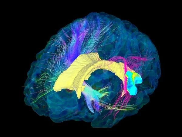 Brain fibres, DTI MRI scan C017  /  7100