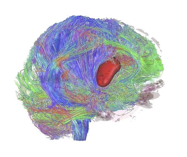 Brain tumour, DTI MRI scan C017  /  7057