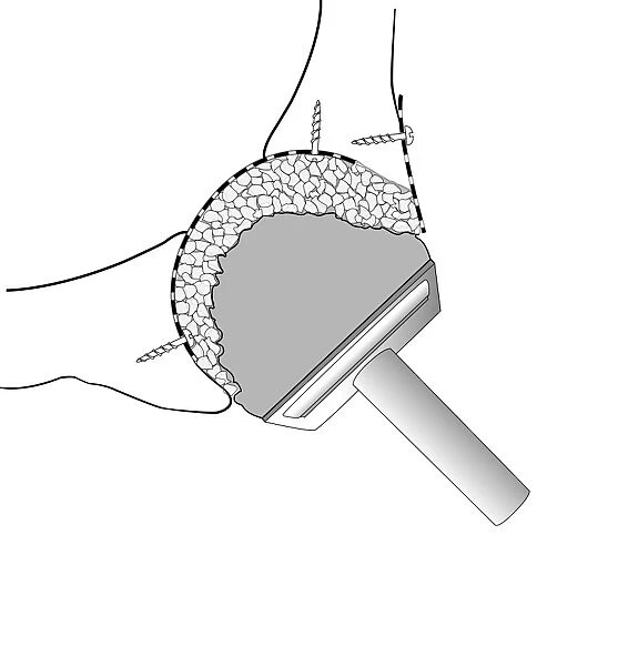 Hip socket bone grafting, diagram C016  /  6785