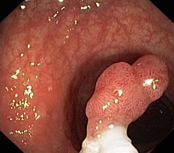 Intestinal polyp removal, endoscopic view C016  /  8325