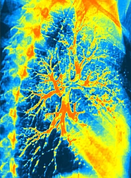 Lung bronchogram, coloured X-ray