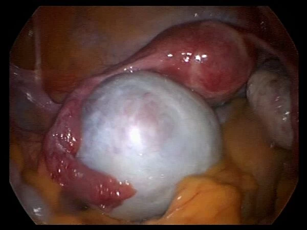 Ovarian cyst, endoscope view C017  /  6800