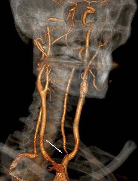 Stenosis of carotid artery, CT scan