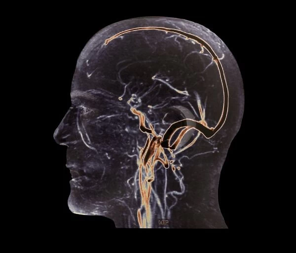 Vascular system of the head, MRI scan