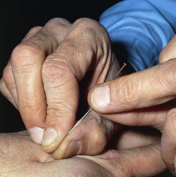 Acupuncture needle insertion technique with rotation