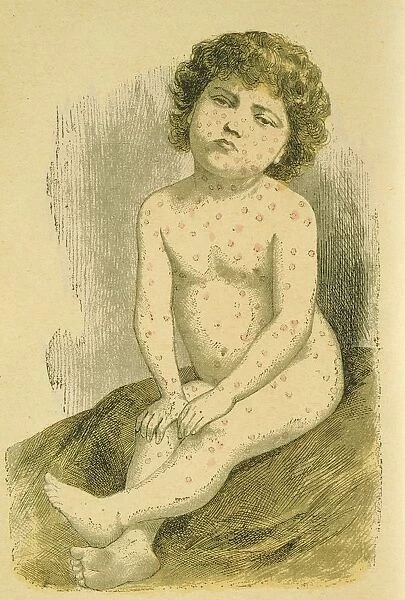 Child suffering from Measles