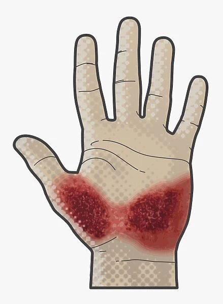 Digital illustration of bleeding wound on palm of hand