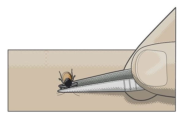 Digital illustration showing removal of tick from human skin using tweezers