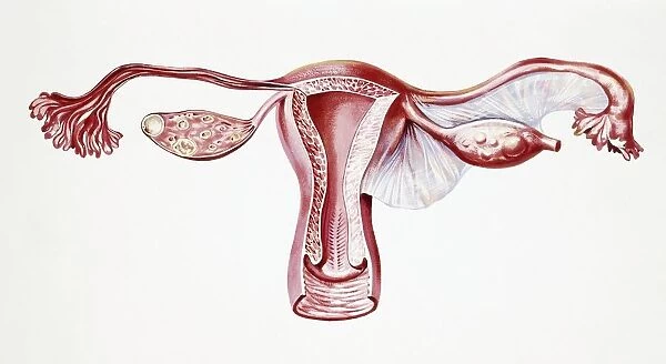 Uterus, Ovary during an ectopic pregnancy, drawing