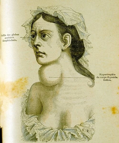 Woman with goitre, Enlargement of thyroid gland