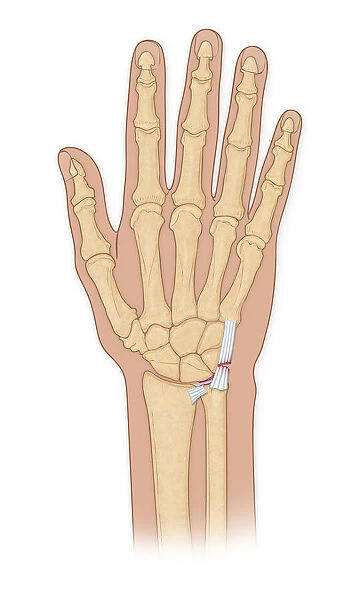 Hand bones with injury