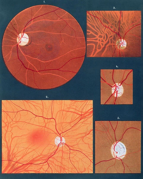 The eye seen through a microscope, from Atlas of Ophthalmoscopy