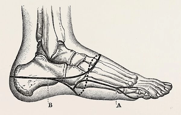 disarticulation of the little toe, medical equipment, surgical instrument, history