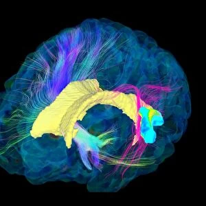 Brain fibres, DTI MRI scan C017 / 7100