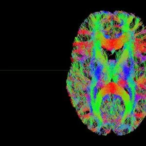 Brain fibres, tract density imaging C017 / 7039