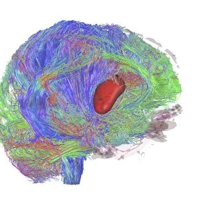 Brain tumour, DTI MRI scan C017 / 7057