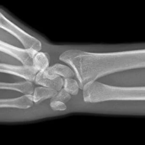 Broken arm, X-ray