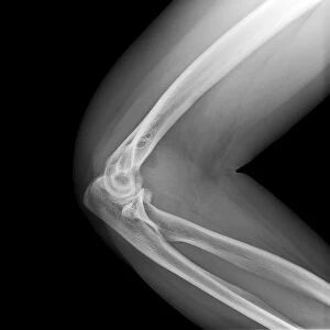 Broken elbow, X-ray C017 / 7750