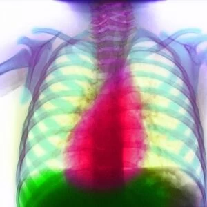 Coloured X-ray of heart showing dextrocardia