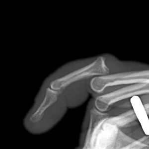 Dislocated finger, X-ray