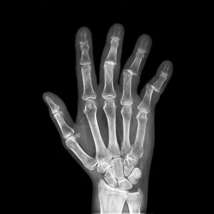 Dislocated fingers, X-ray C017 / 7754