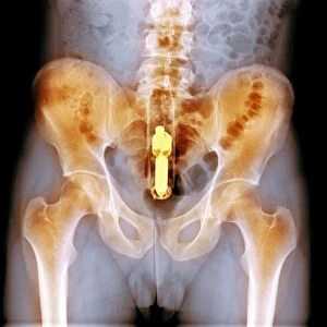 Foreign object in rectum, X-ray F008 / 3478