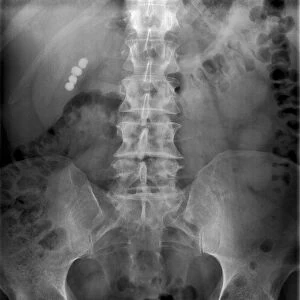 Gallstones, X-ray C017 / 7860