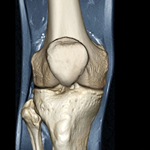 Healthy knee, CT scan C018 / 0413
