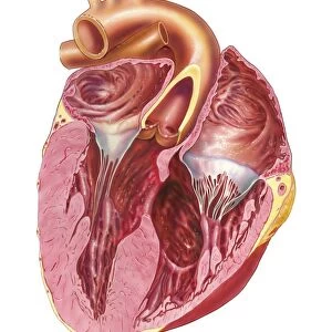 Heart chamber wall defect, artwork