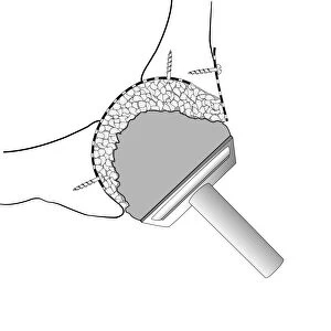 Hip socket bone grafting, diagram C016 / 6785