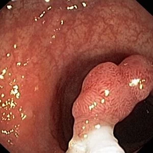 Intestinal polyp removal, endoscopic view C016 / 8325
