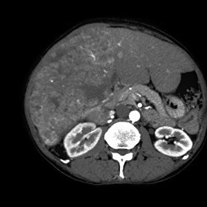 Liver cancer, CT scan C018 / 0462
