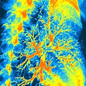Lung bronchogram, coloured X-ray