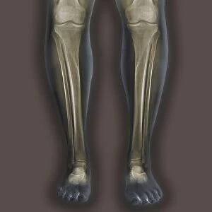 Normal legs, X-rays