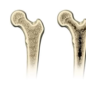 Osteoporosis, artwork