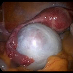 Ovarian cyst, endoscope view C017 / 6800