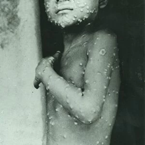 Last case of Smallpox, India