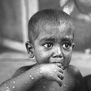 Child with Smallpox