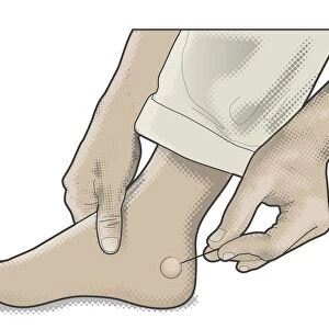 Digital illustration of man using sterilized needle to pierce blister on foot