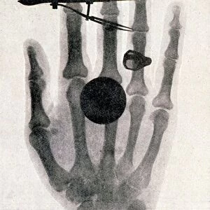 Wilhelm Roentgens (1845-1923) X-ray photograph of his wifes hand: 1896