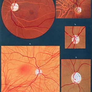 The eye seen through a microscope, from Atlas of Ophthalmoscopy